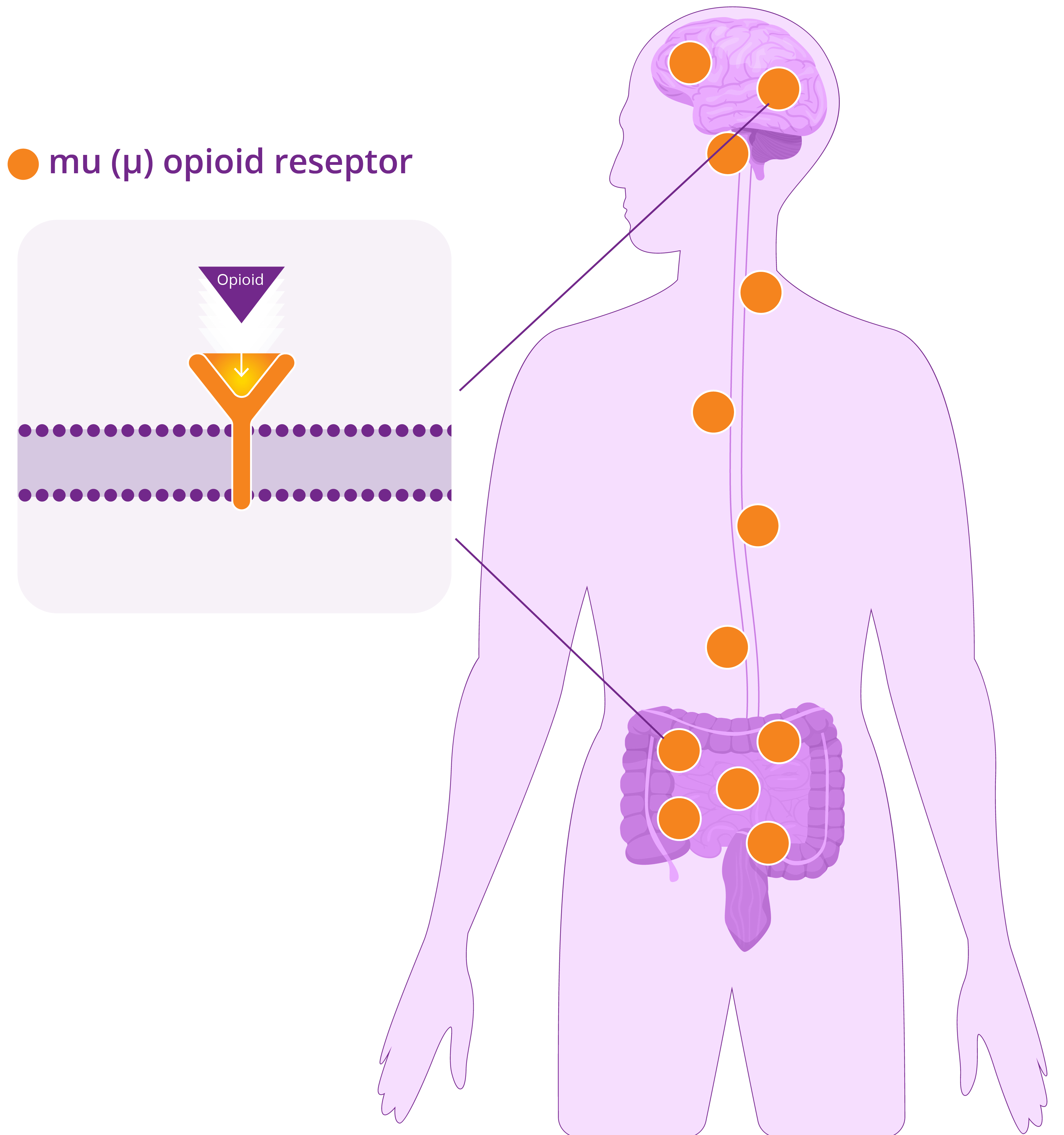 Opioidindusert forstoppelse: pasientbelastning og utfordringer knyttet til oppfølging