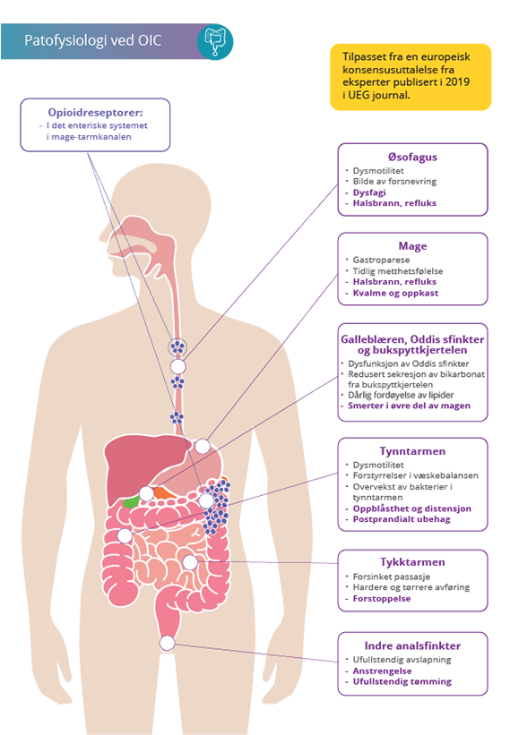 Opioidindusert forstoppelse: pasientbelastning og utfordringer knyttet til oppfølging