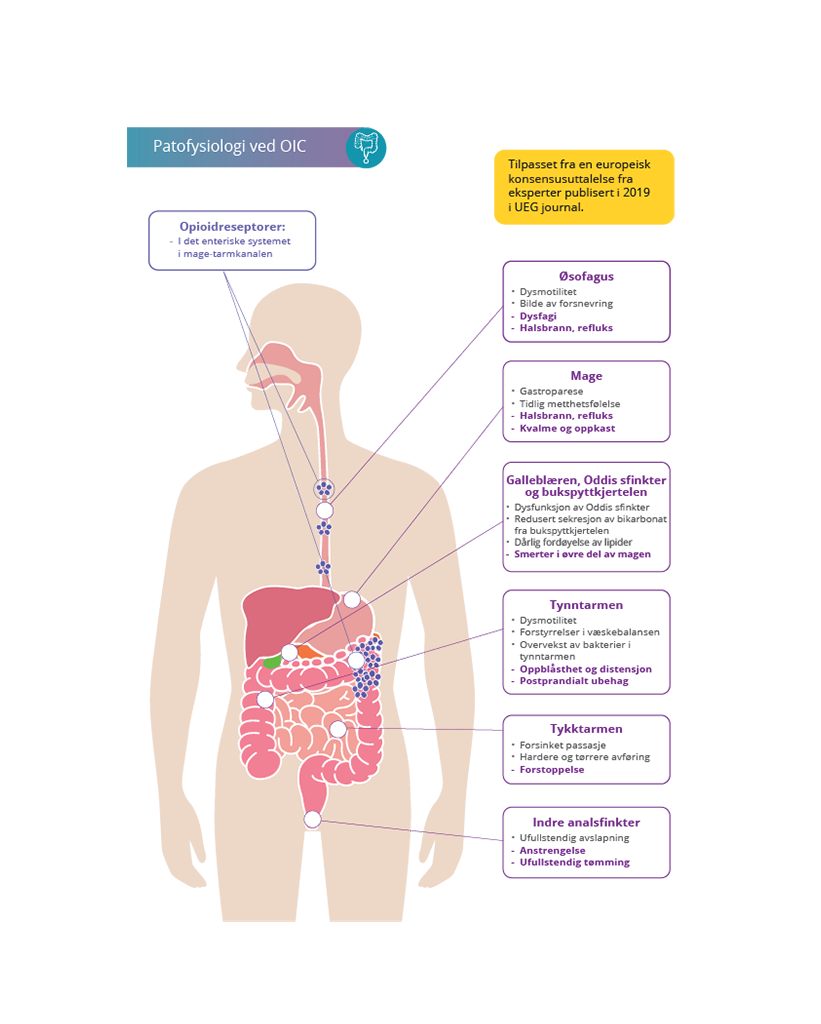 Opioidindusert forstoppelse: pasientbelastning og utfordringer knyttet til oppfølging