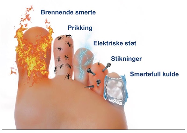 Diabetisk perifer nevropati_2