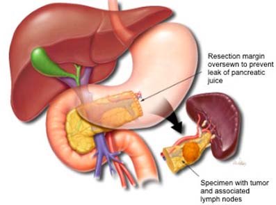 Om pankreaskirugi og EPI