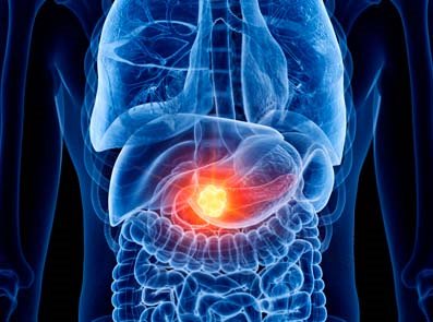 Pankreas cancer