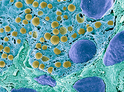EPI og kronisk pankreatitt